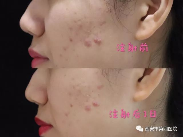 最新痤疮治疗技术，开启美丽肌肤之门